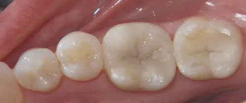 Caso Clínico: Dientes restaurados estéticamente con resinas compuestas del mismo color del diente.