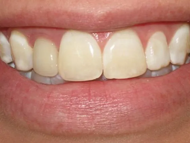 Caso Clínico de Diseño de Sonrisa: Vista frontal de diastemas y discromía antes del tratamiento.