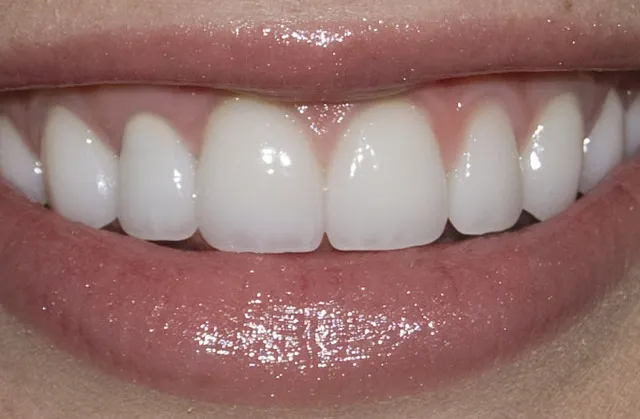 Caso Clínico de Diseño de Sonrisa: Sonrisa restaurada con carillas de porcelana tras finalizar el tratamiento.